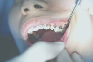 Resonance frequency analysis of orthodontic miniscrews subjected to light-emitting diode photobiomodulation therapy