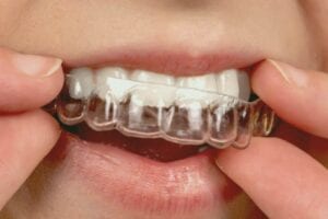 Effect of high-frequency vibration on orthodontic tooth movement and bone density